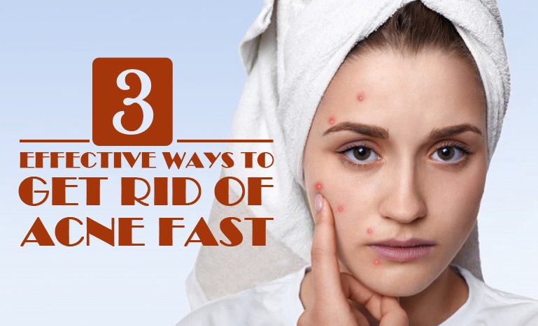 3 Effective Ways to Get Rid of Acne Fast | Shop List